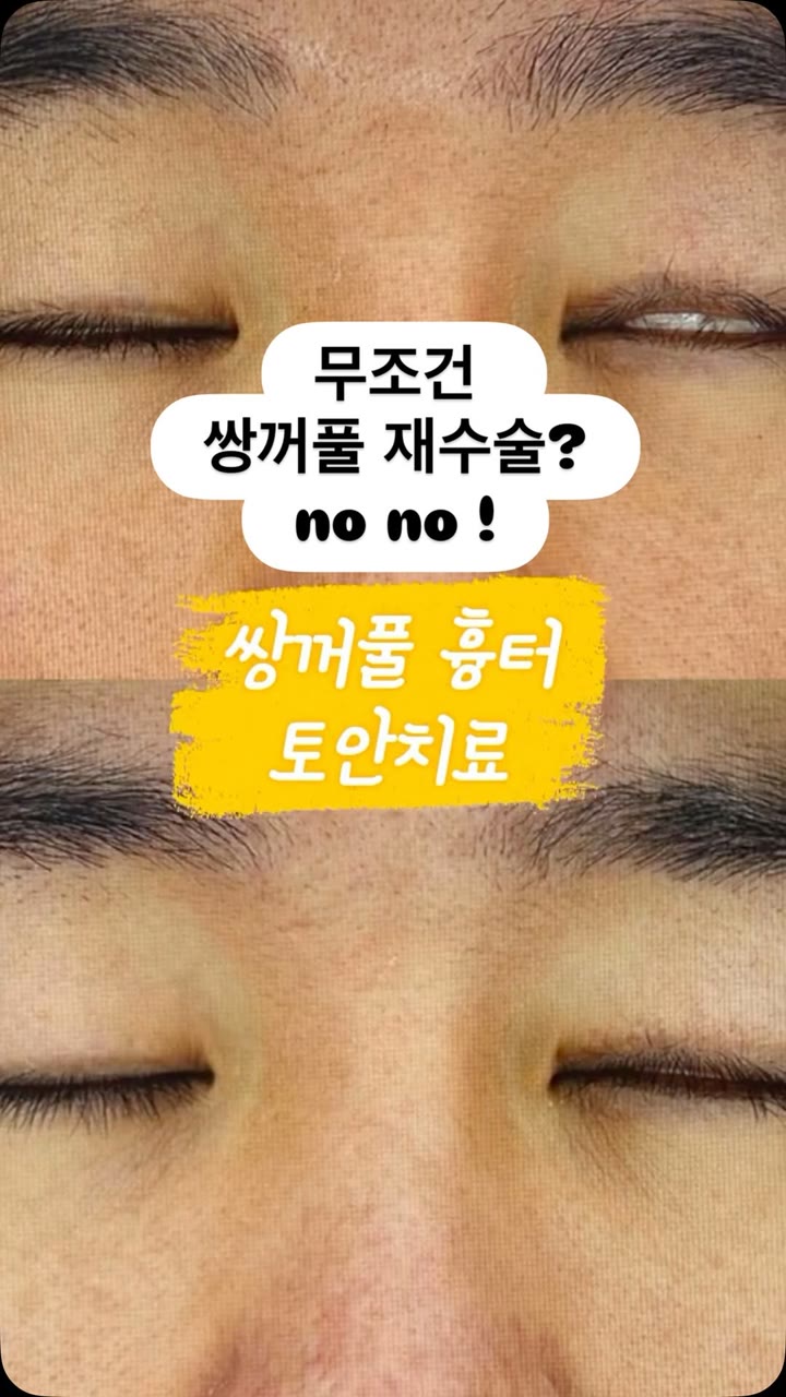 쌍꺼풀 수술 후 불편함, 비수술 치료