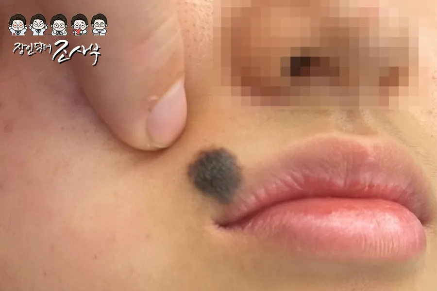 큰 코끝점 6개월 단계적 제거 전