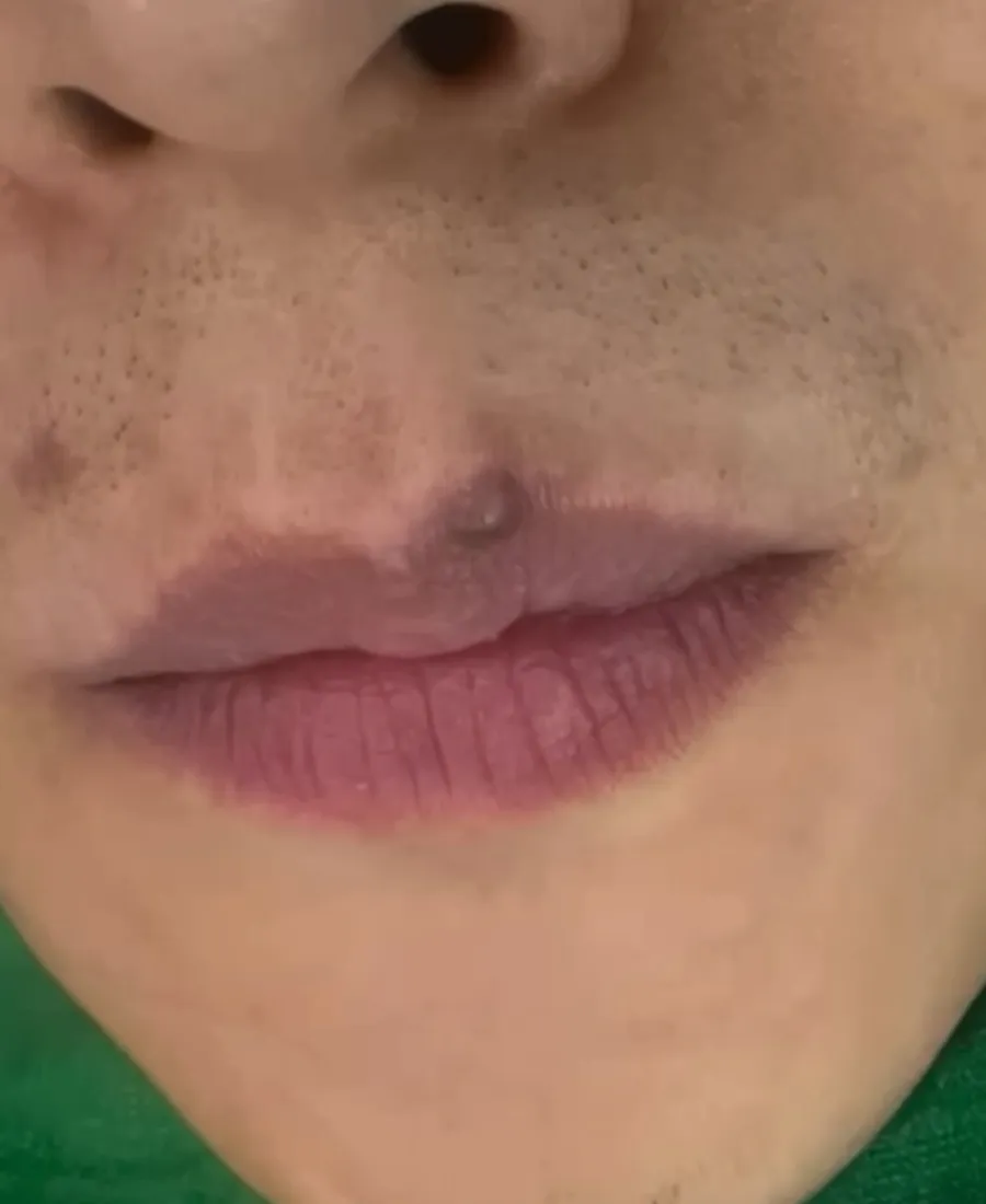 입술 라인 점 제거 전
