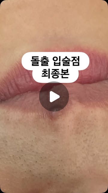 입가점 제거