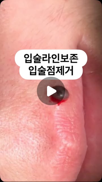 장인닥터 인중점제거 Instagram Reels