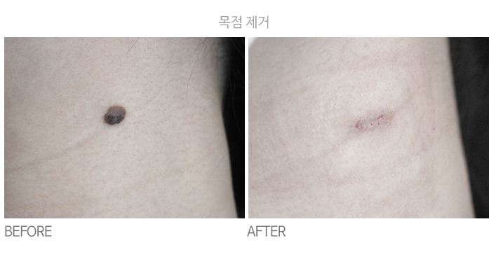 목점 제거 전후