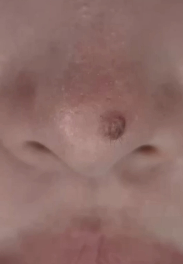 코점 분할 제거 초기 회차 직후