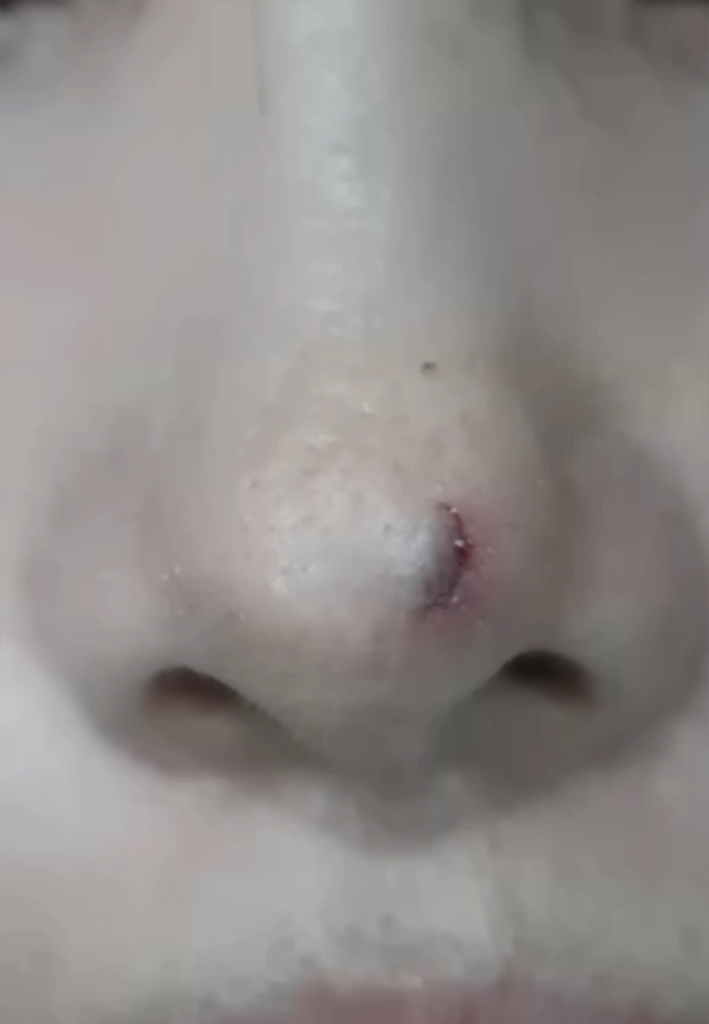 코점 분할 제거 중간 회차 경과