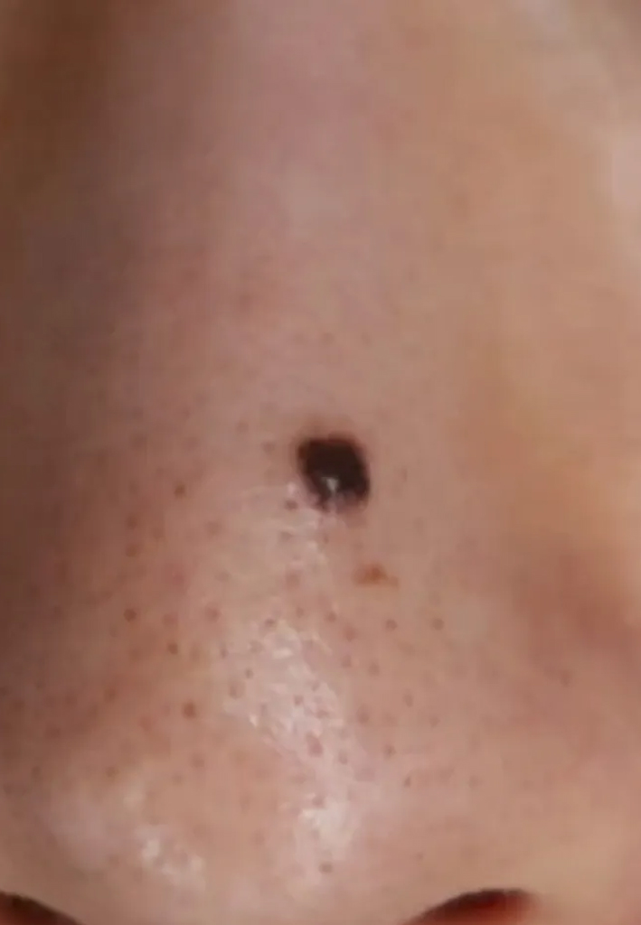 코점조각술 전