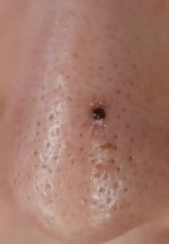 코점조각술 2회 후