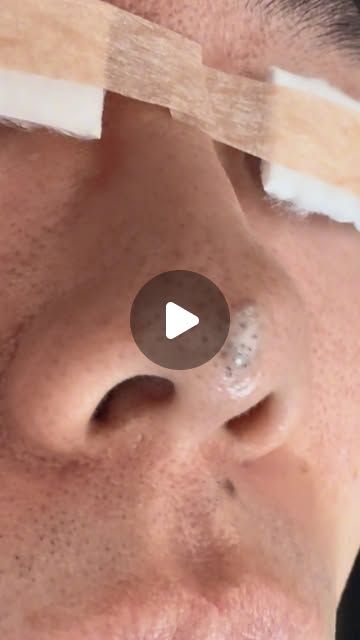 코점제거