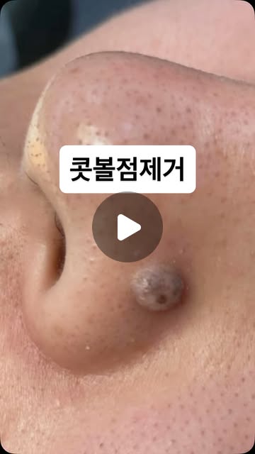 장인닥터 콧볼점제거 Instagram Reels