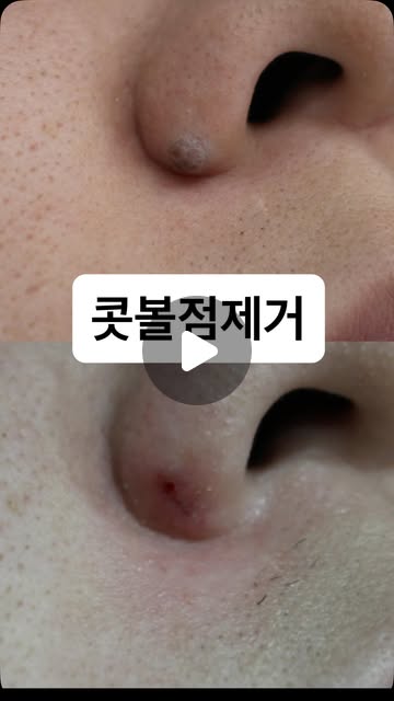 콧볼점제거