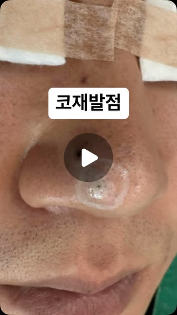 코재발점 제거