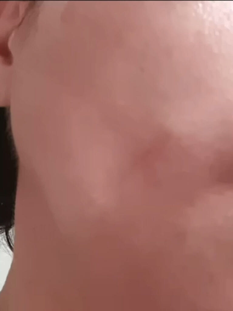 큰 볼점 절제·봉합 분할 제거 후 회복된 모습