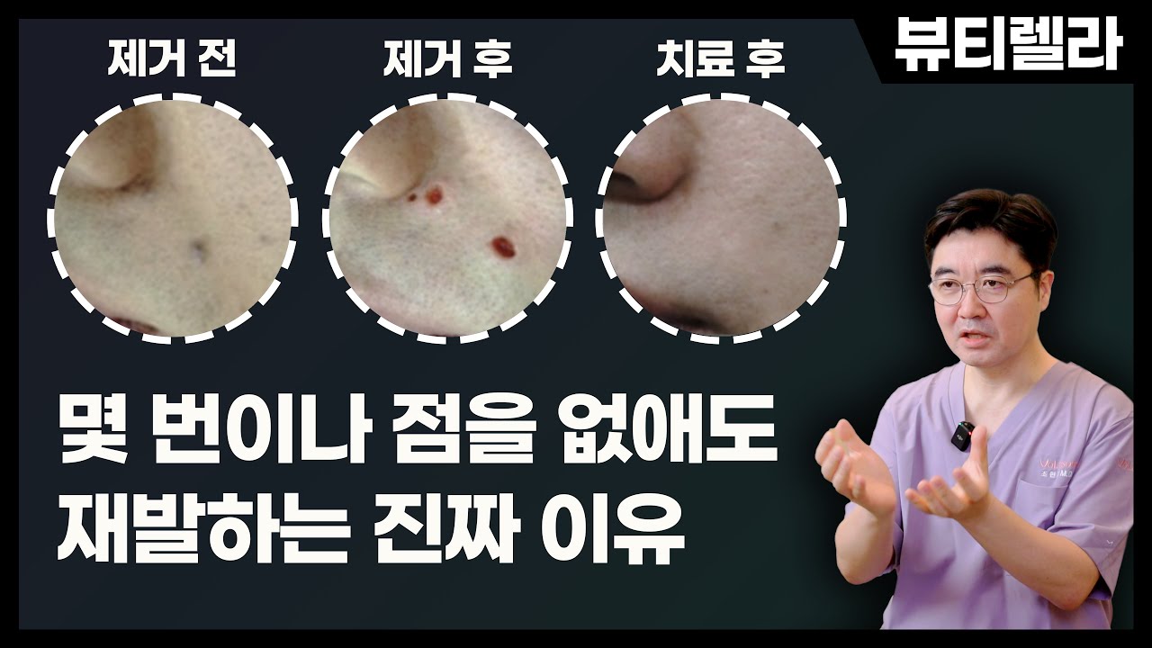 없애도 계속 재발하는 점의 원인을 설명하는 조현진 대표원장 영상 썸네일