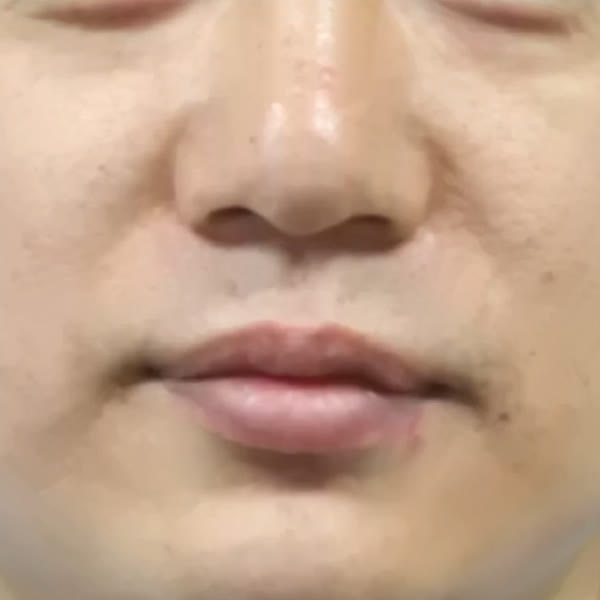 재발점 4개 돌려깎기 제거 후 회복된 모습