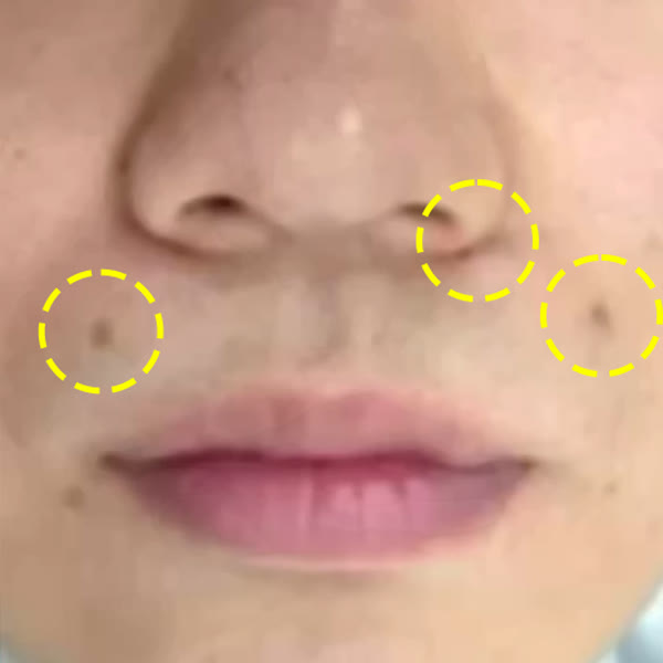 코 주변과 입가에 재발한 점, 노란 원으로 표시