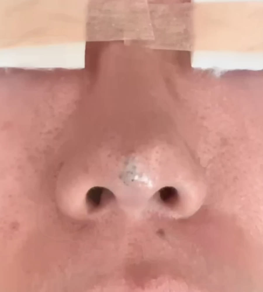 5번 재발한 코끝점 제거 전