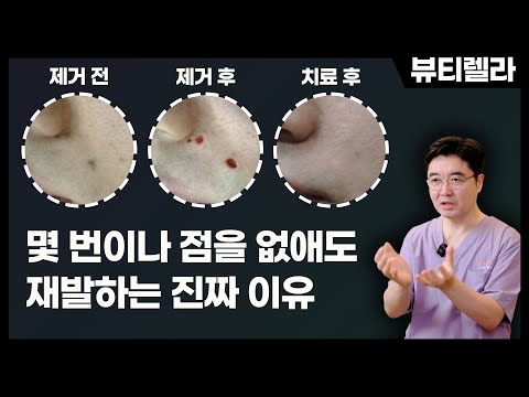 없애도 계속 재발하는 점, 도대체 왜그럴까?