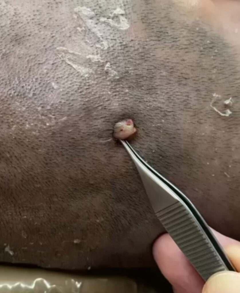 뒤통수 돌출 두피점 제거 전