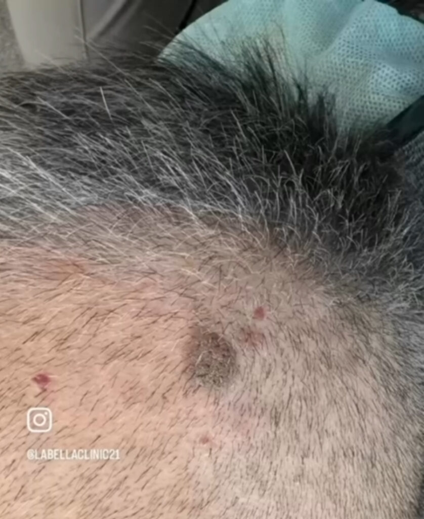 머리카락 사이 두피점 제거 전