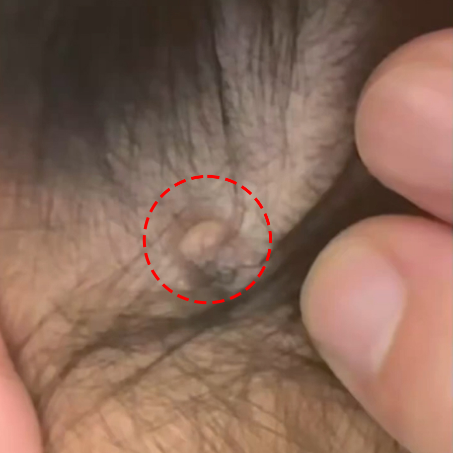 머리카락이 자라는 두피점 제거 전