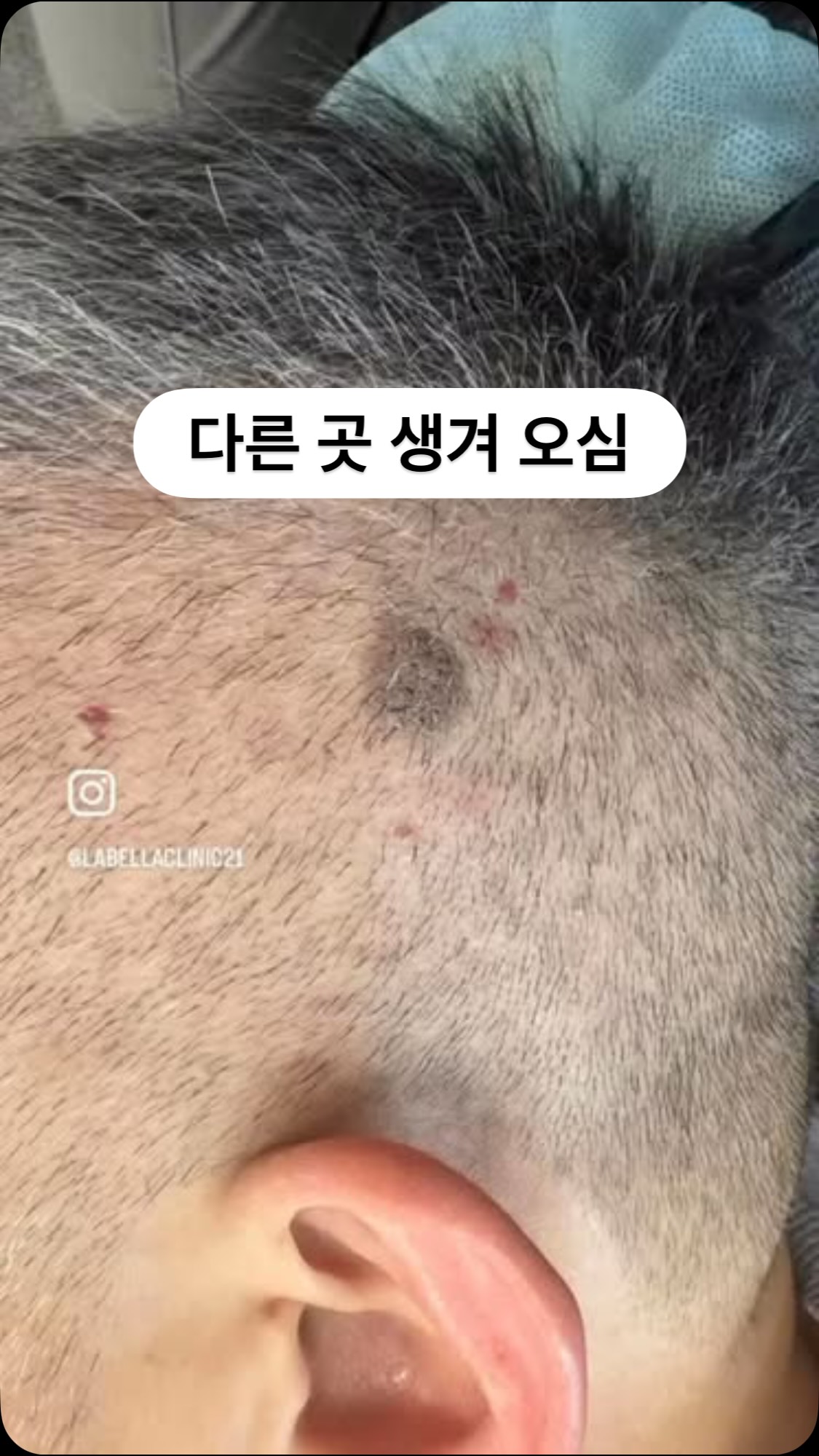머리카락 보존을 고려한 두피점 제거 치료 경과 Instagram Reels
