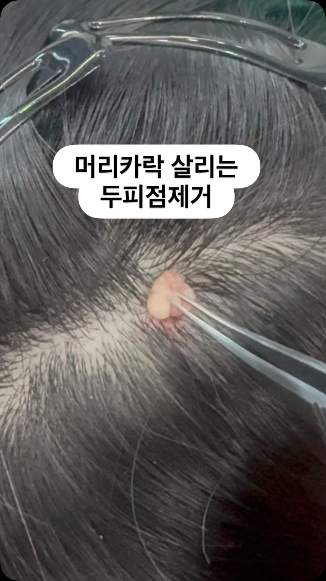 점은 줄이고 머리카락은 보존하는 두피점 제거 Instagram Reels