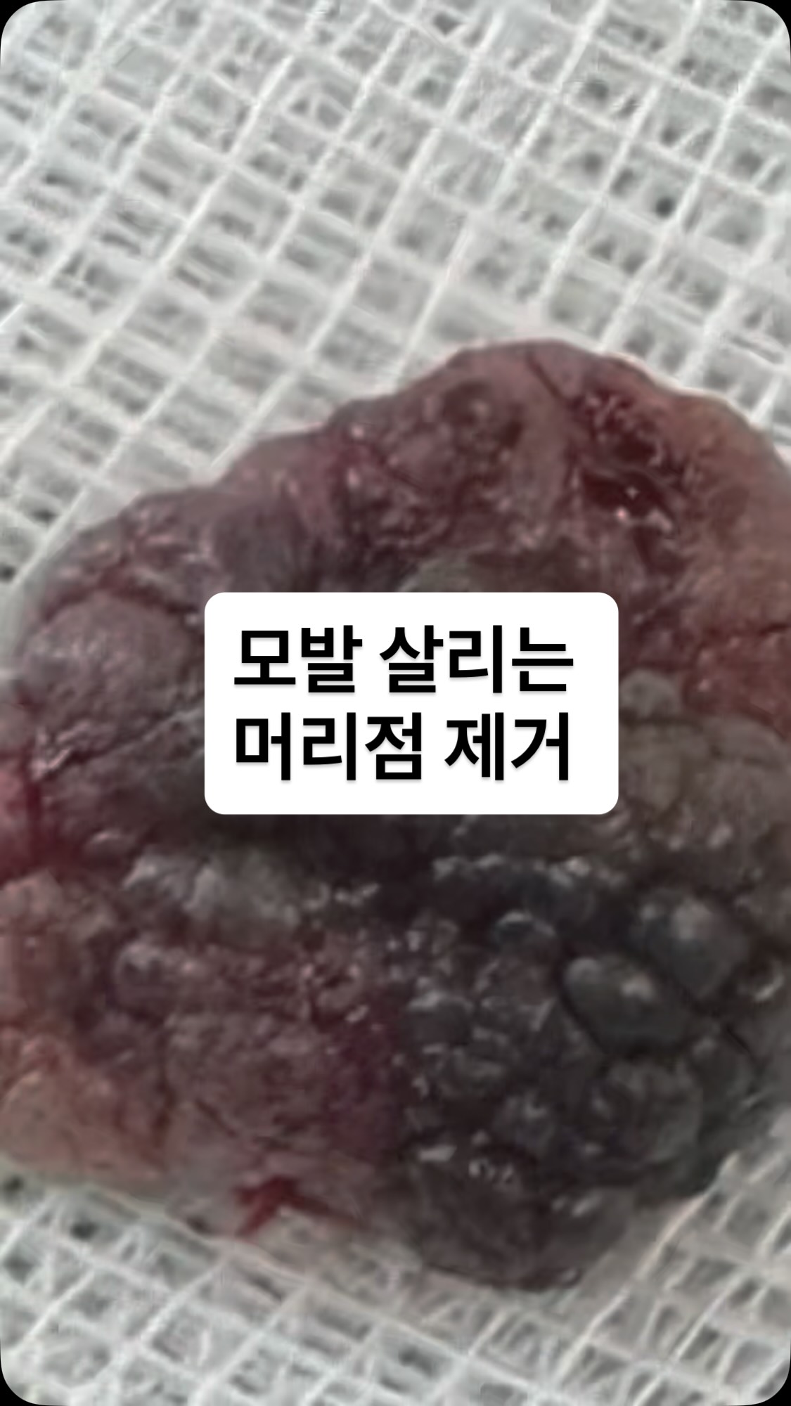 모근을 살리고 다음 날 샴푸가 가능한 머리점 제거 Instagram Reels