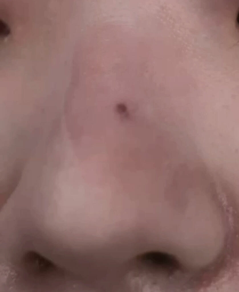코점 조각술 후 작아진 매력점
